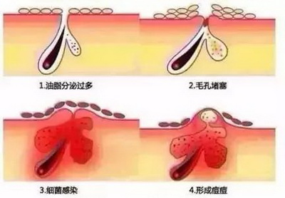 怎么才能消除脸上的痘坑痘印